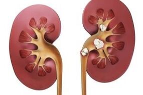 Kidney stones are a contraindication to a protein diet